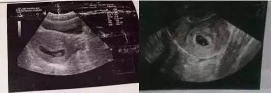 早期孕囊形状看男女