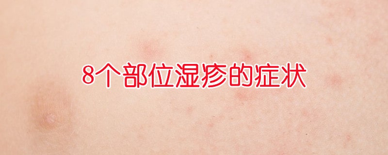 8个部位湿疹的症状