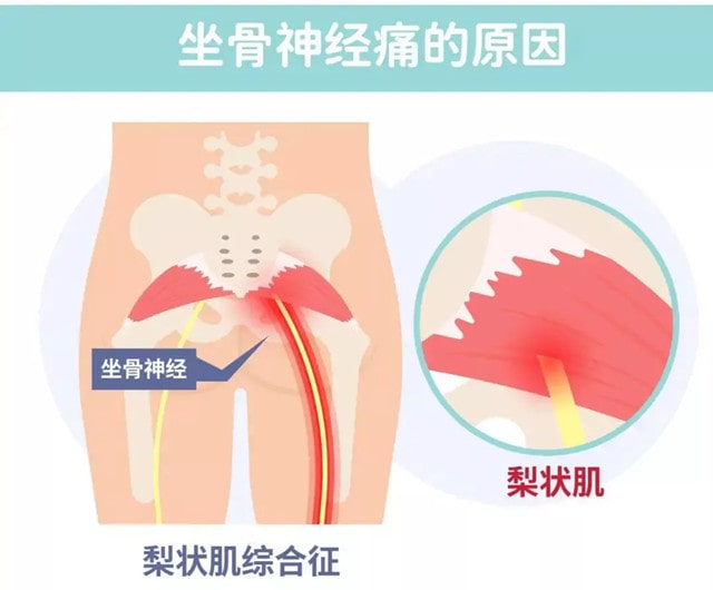 久坐腰疼怎么缓解