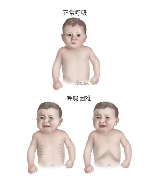 怎么判断宝宝是不是得了肺炎？