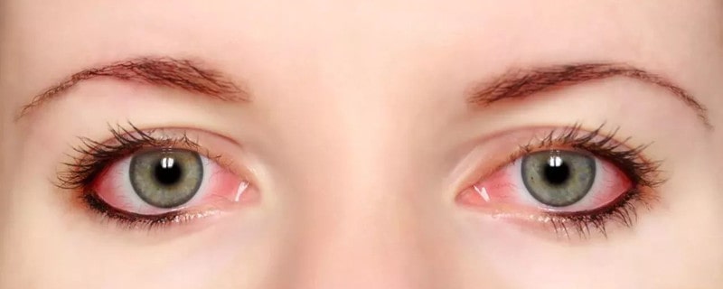 孕妇得了红眼病能自愈吗