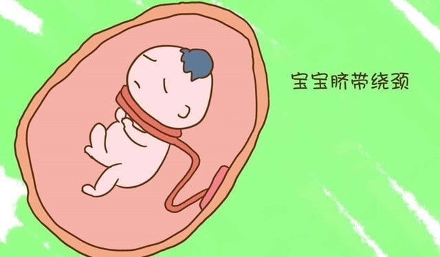 准妈妈如何应对脐带绕颈？