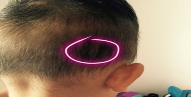 儿童有白头发怎么办