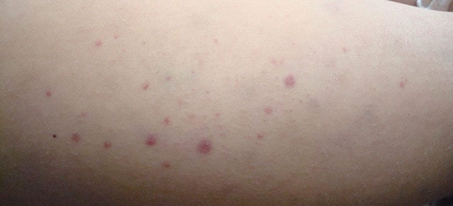 宝宝得了过敏性紫癜怎么办？