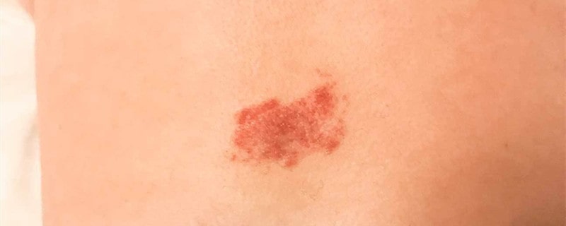 婴儿血管瘤多久消失