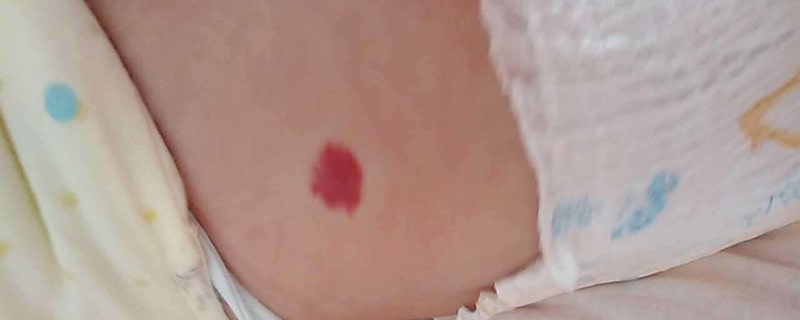 婴儿血管瘤消退后有哪些后遗症