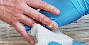 烫伤后怎么处理好得快？