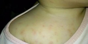 宝宝湿疹怎么办