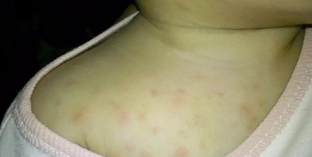 宝宝湿疹怎么办