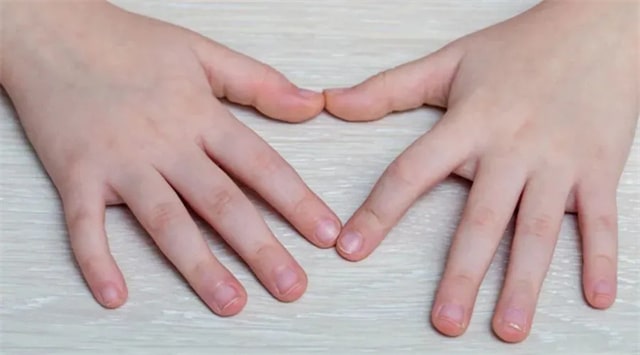 宝宝指甲透露的5种健康信号