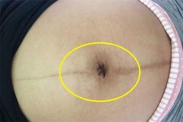 孕妇肚脐有凹有凸，和生男生女有关？