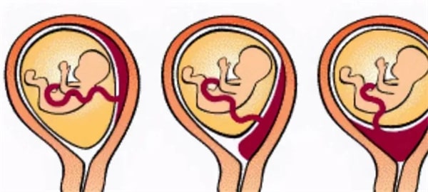 孕妇肚脐有凹有凸，和生男生女有关？