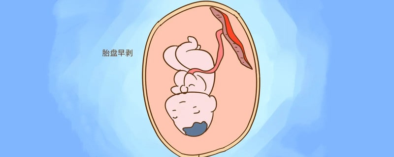 什么是胎盘早剥？