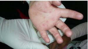 手足口病症状初期图片