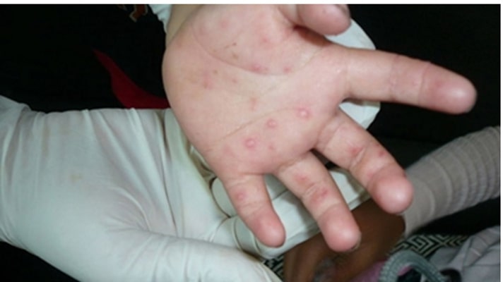 手足口病症状初期图片