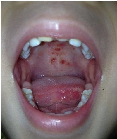 手足口病症状初期图片