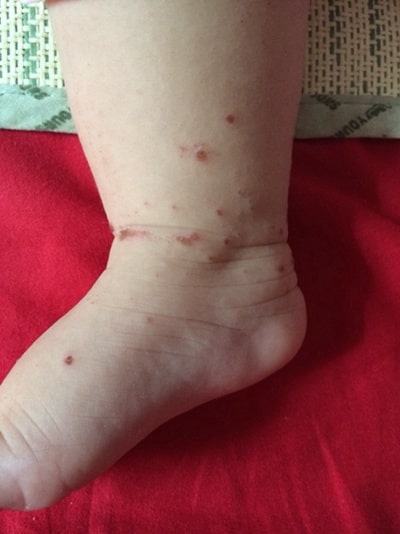 手足口病症状初期图片