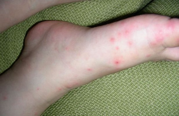 手足口病症状初期图片