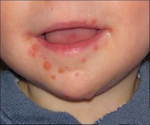 手足口病症状初期图片