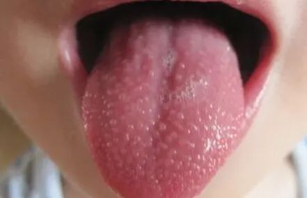 春季请警惕小儿高发的这8种皮疹