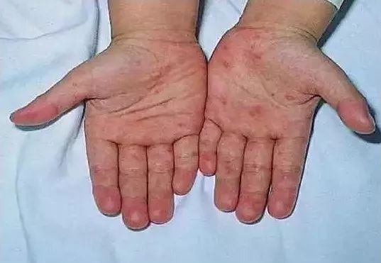 春季请警惕小儿高发的这8种皮疹