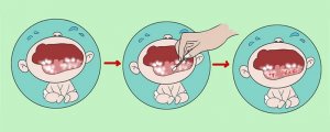婴儿鹅口疮最佳治疗方法