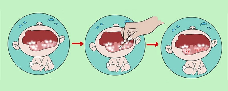 婴儿鹅口疮最佳治疗方法