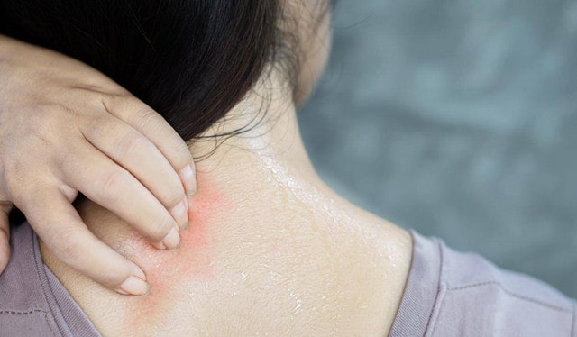 孕期皮肤过敏怎么办？