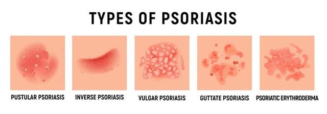 孕期外阴湿疹怎么办？