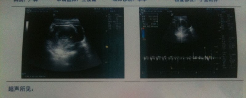 b超对胎儿有影响吗