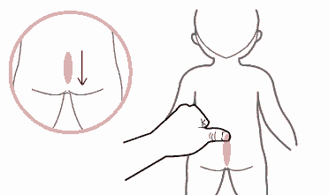 小儿推拿治疗积食方法