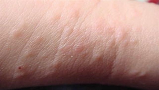 湿疹和热疹的区别图片