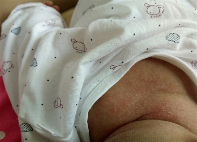 湿疹和热疹的区别图片