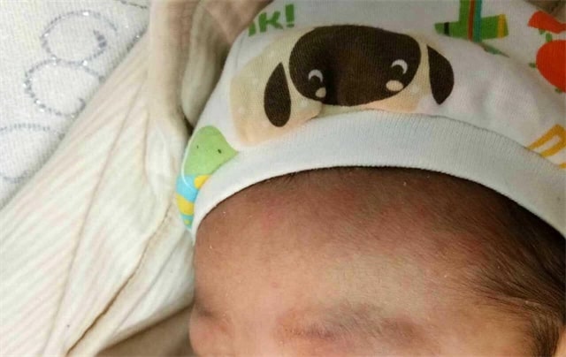 湿疹和热疹的区别图片