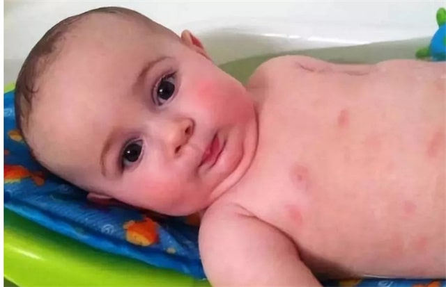 湿疹和热疹的区别图片