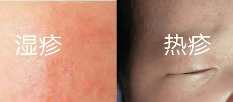 湿疹和热疹的区别图片