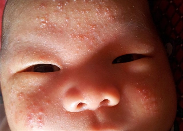 湿疹和热疹的区别图片