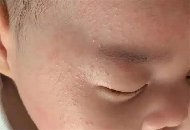 湿疹和热疹的区别图片