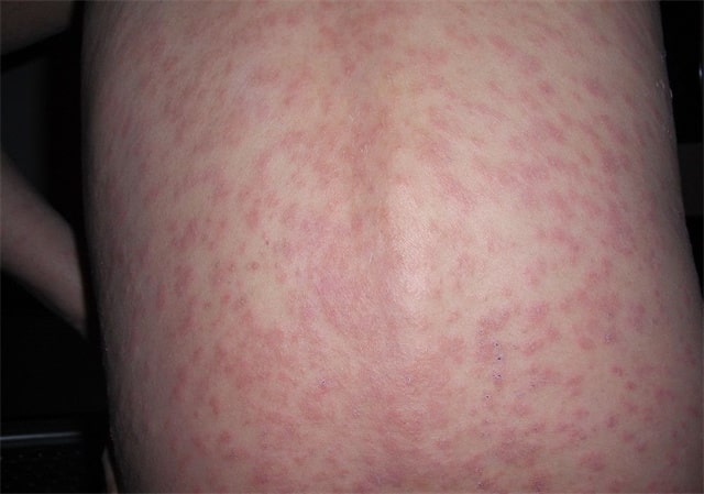 湿疹和热疹的区别图片