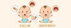 疱疹性咽颊炎和手足口病的区别