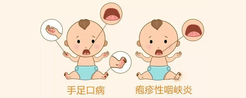 疱疹性咽颊炎和手足口病的区别
