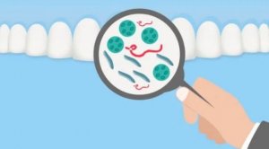 引起牙周炎的原因有哪些？