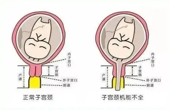 宫颈机能不全如何顺利孕育分娩健康的宝宝？