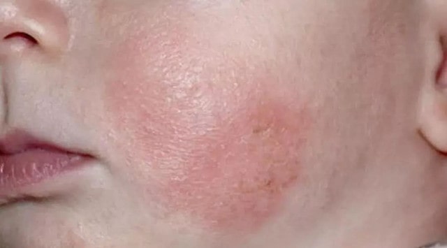 痱子和湿疹的区别