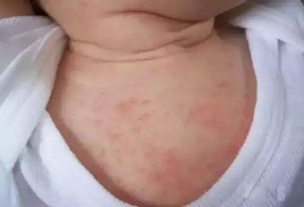 婴儿湿疹怎么办