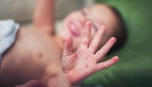 秋季5种儿童常见疾病及预防措施