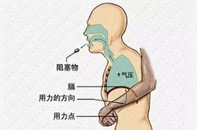 幼儿园小孩呼吸道气管有异物怎么办