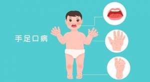 幼儿园手足口病防控工作预案