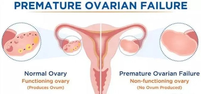 15%的不孕女性存在排卵障碍
