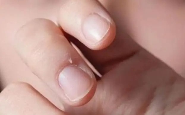 儿童手上长刺的原因